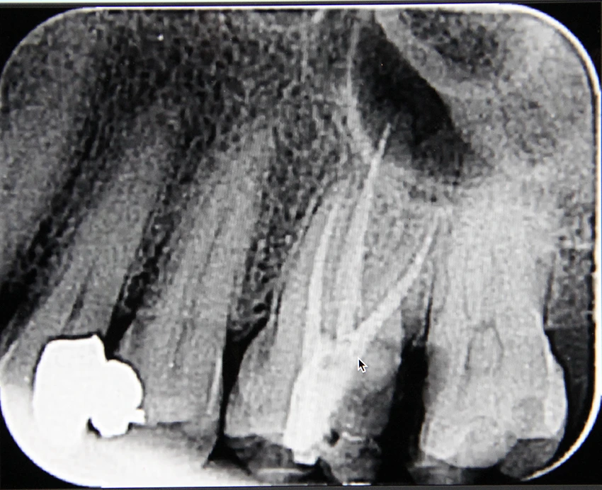 After: Before and after X-ray of a complex molar root canal treatment showing successful canal sealing at Maypole Dentistry.
