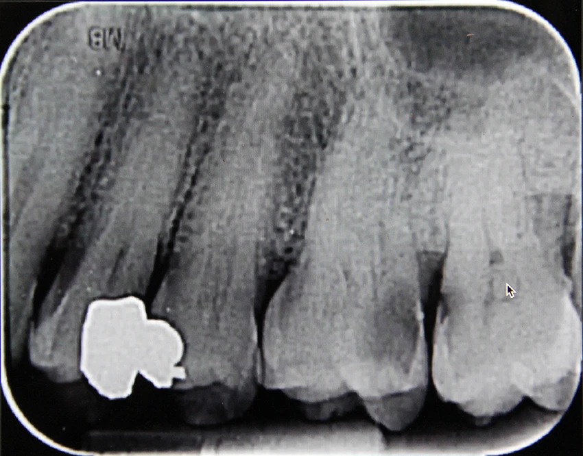 Before: Before and after X-ray of a complex molar root canal treatment showing successful canal sealing at Maypole Dentistry.