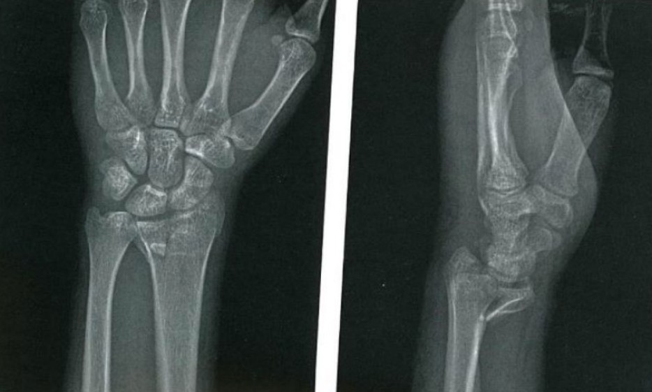 Wrist injury
