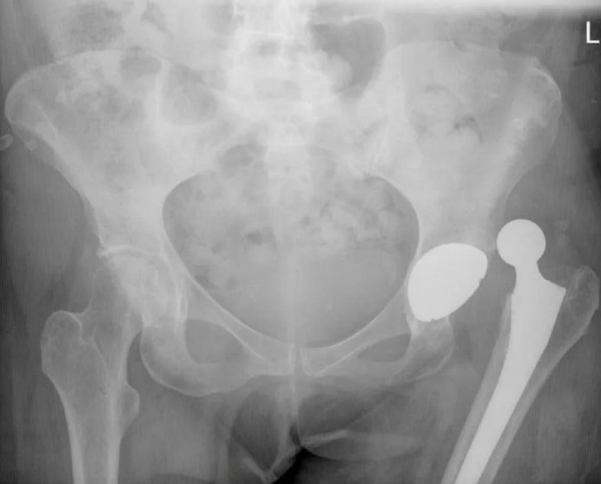 Dislocated hip arthroplasty