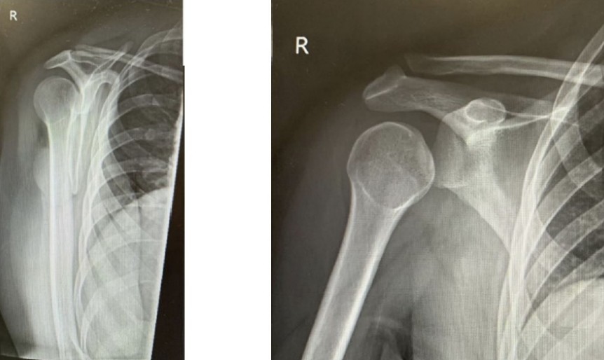 Acute shoulder injury