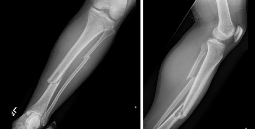 Lower limb long bone fracture