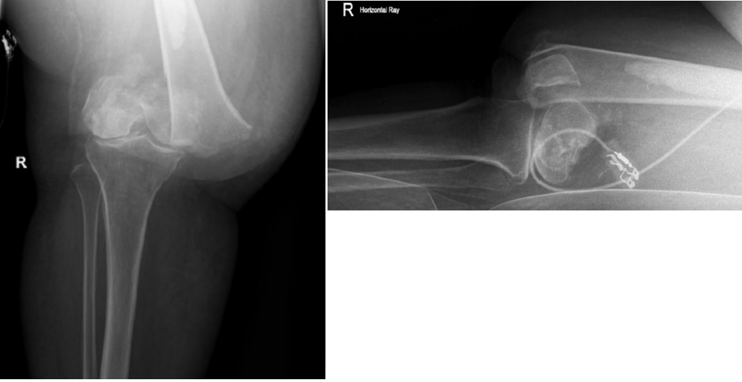 Swollen Knee