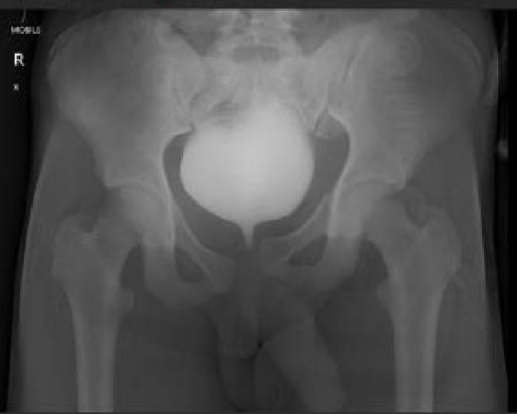 Pelvic Trauma