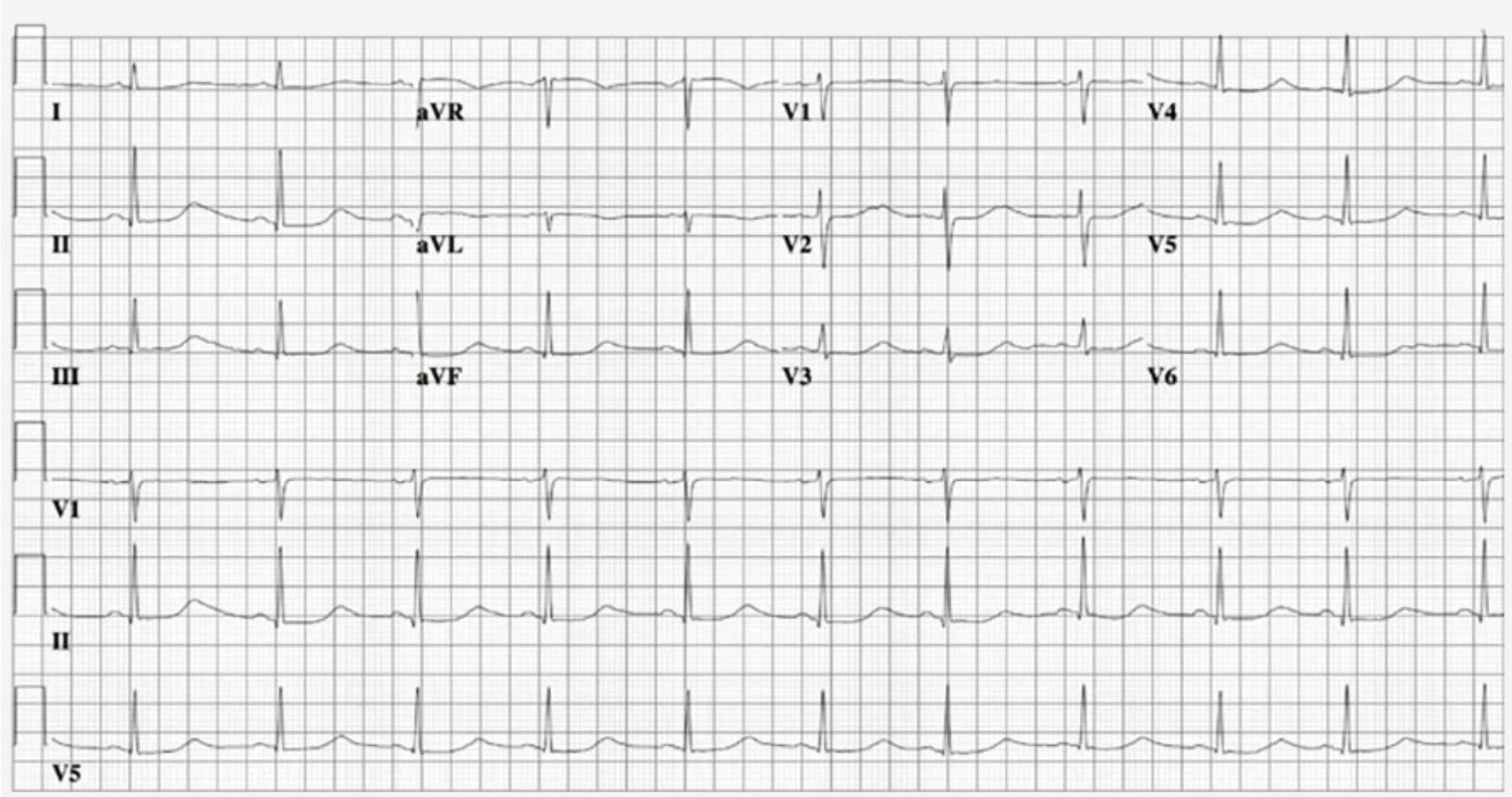 Nightclub Syncope