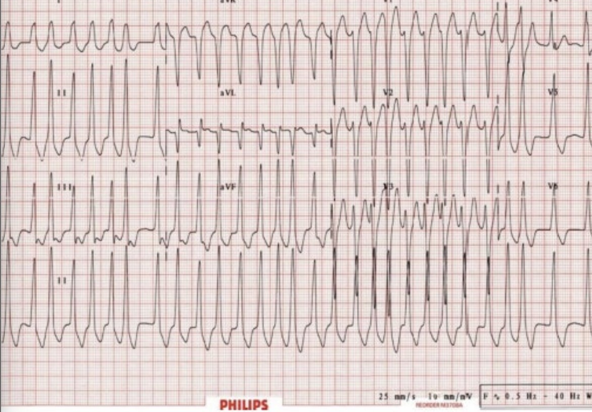 Pregnancy Palpitations