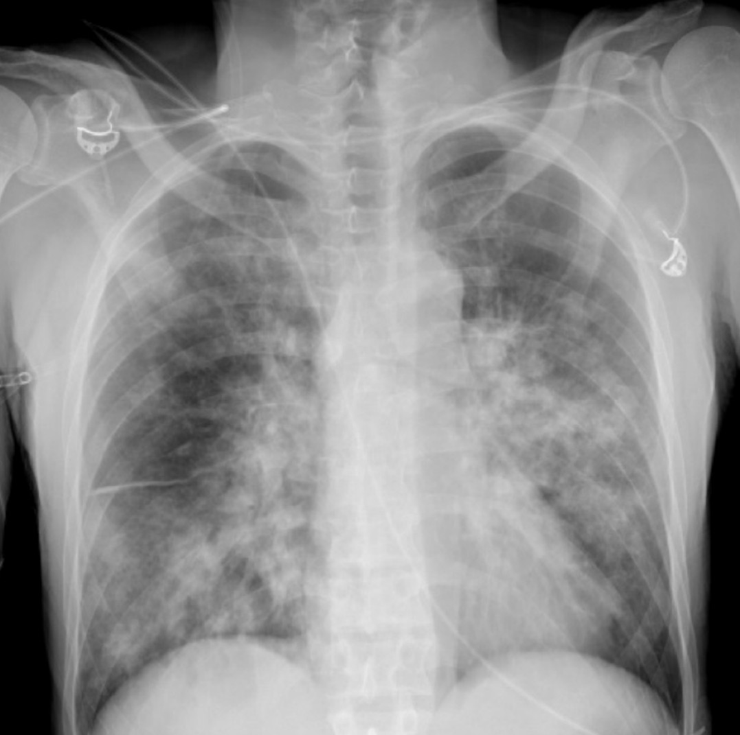 Fever and Breathlessness