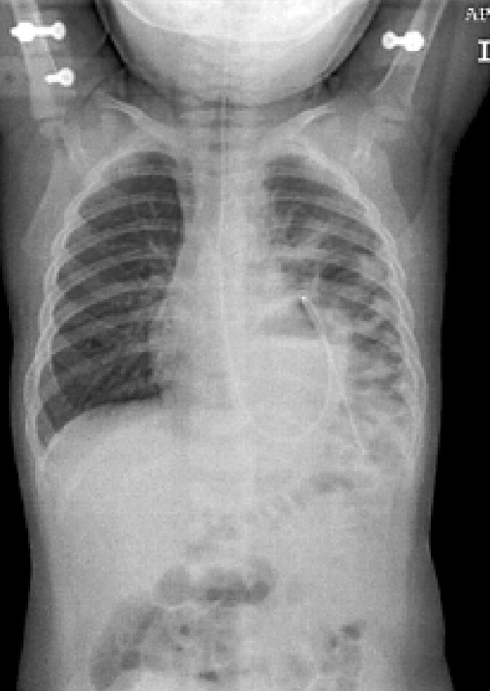 Febrile Toddler