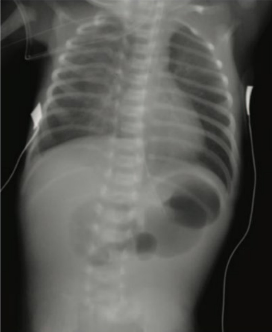 Neonate with Bilious Vomiting