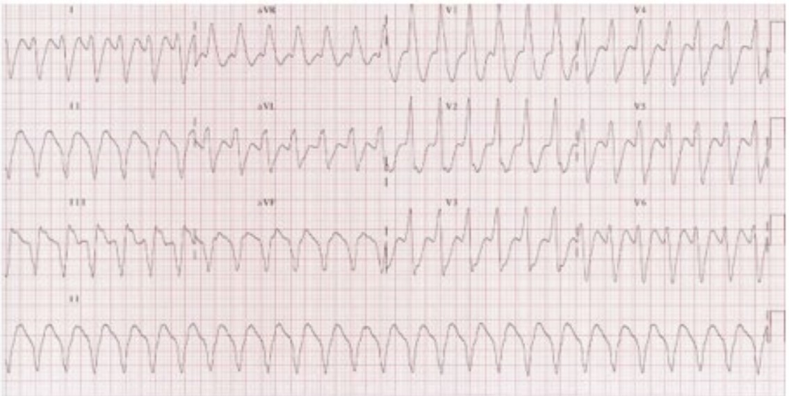 Recurrent Palpitations