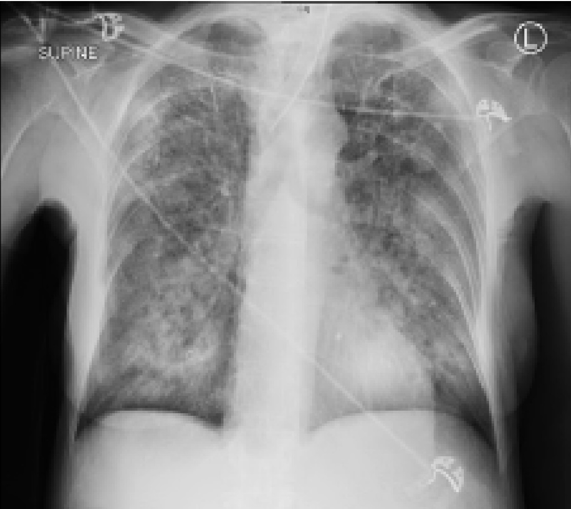 Septic Respiratory Failure