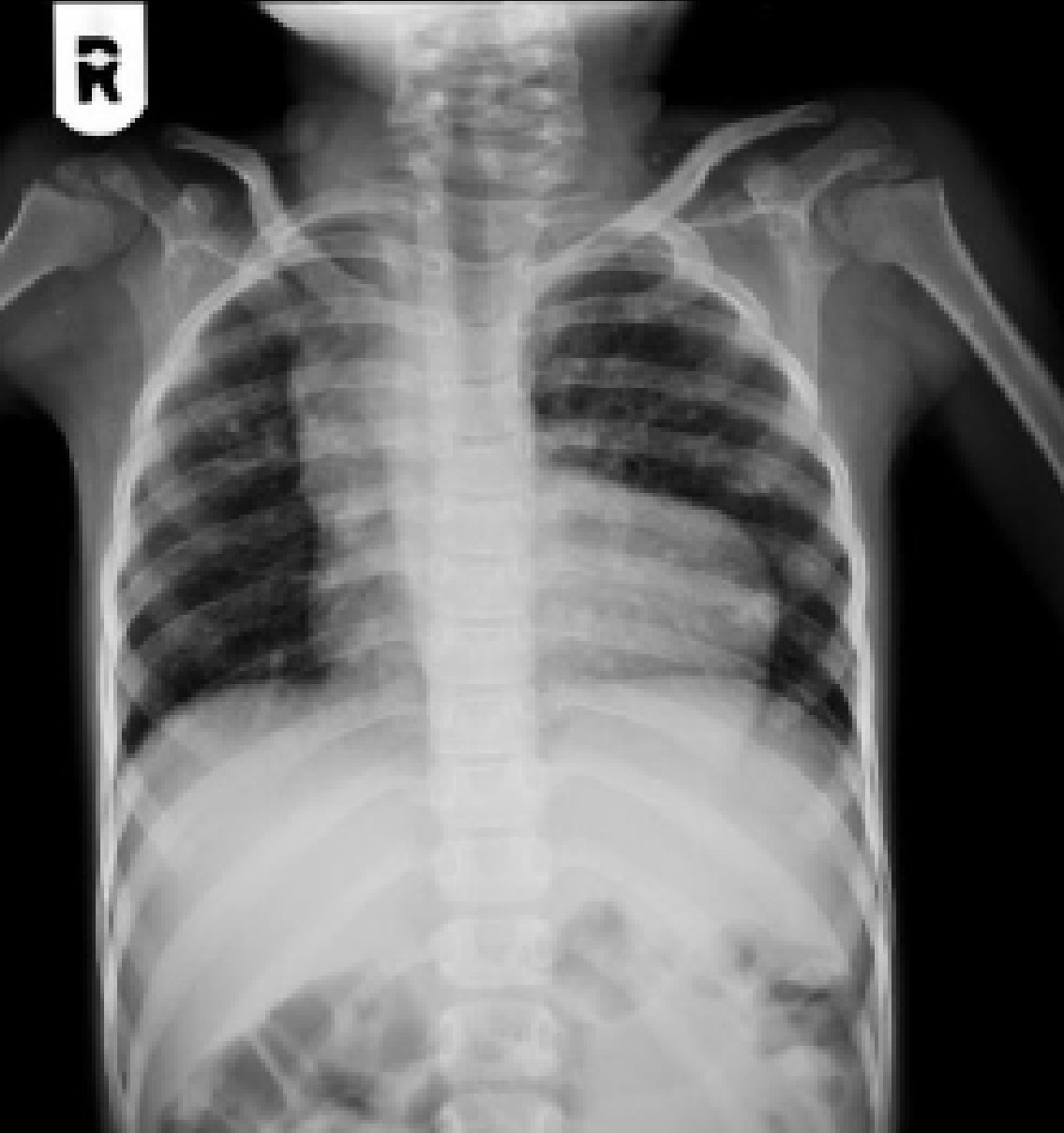 Neonatal Cyanotic Episodes