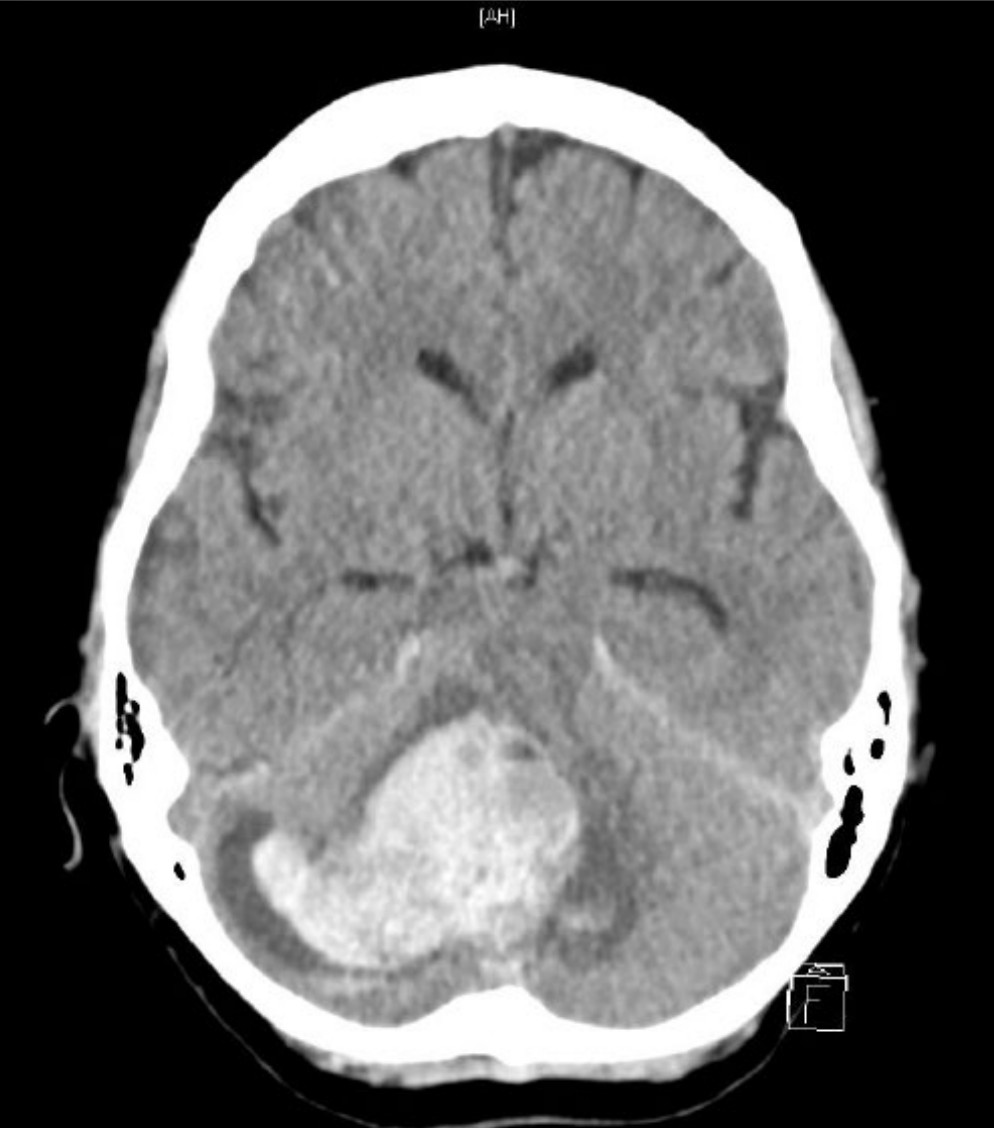 Acute Cerebellar Event