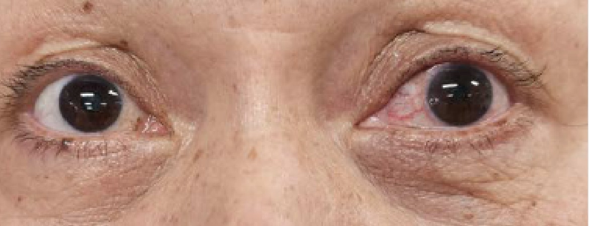 Acute Red Eye