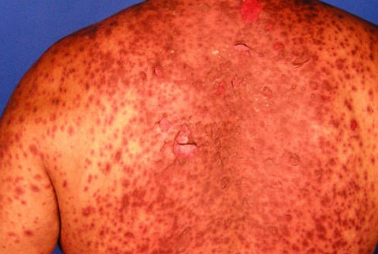 Rash