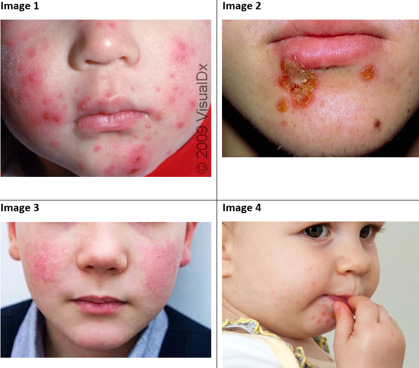 Rashes