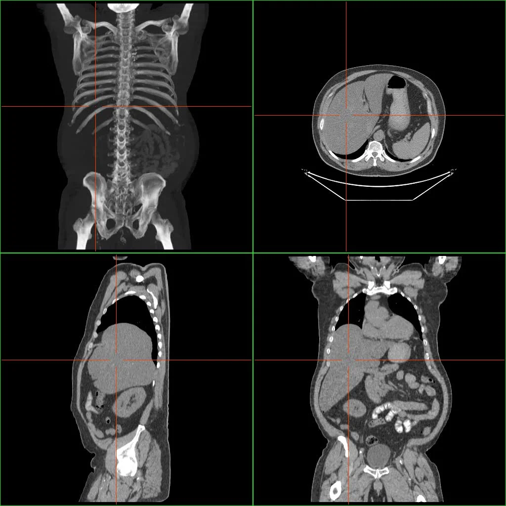 enlarged-liver