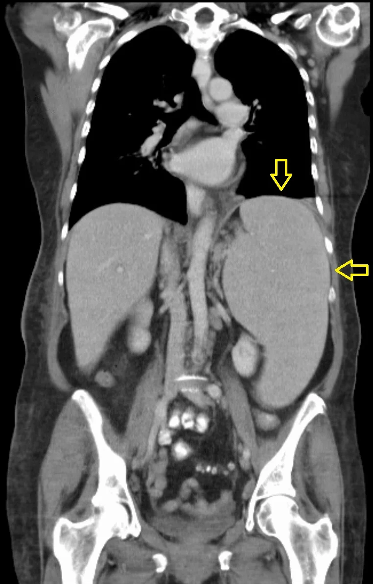 splenomegaly