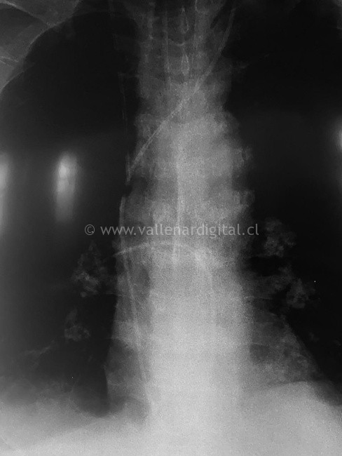 Equipo clínico de HPH realiza inédito procedimiento en paciente cardiológico