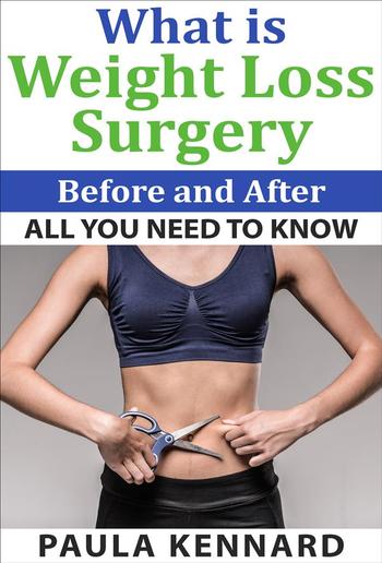 What Is Weight Loss Surgery: All You Need To Know Before And After PDF