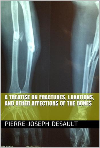 A Treatise on Fractures, Luxations, and other Affections of the Bones PDF