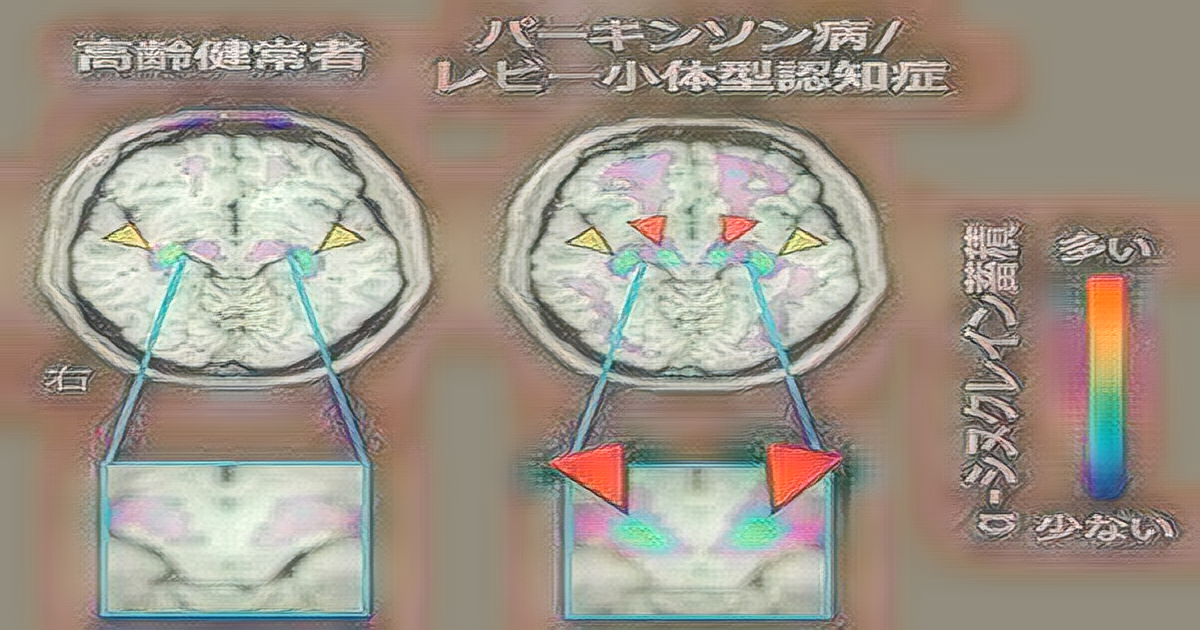 Breakthrough in Visualizing Alpha-Synuclein Accumulation in Parkinson's and Lewy Body Dementia Breakthrough in Visualizing Alpha-Synuclein Accumulation in Parkinson's and Lewy Body Dementia