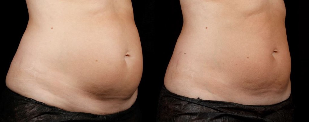 SculpSure Before and After