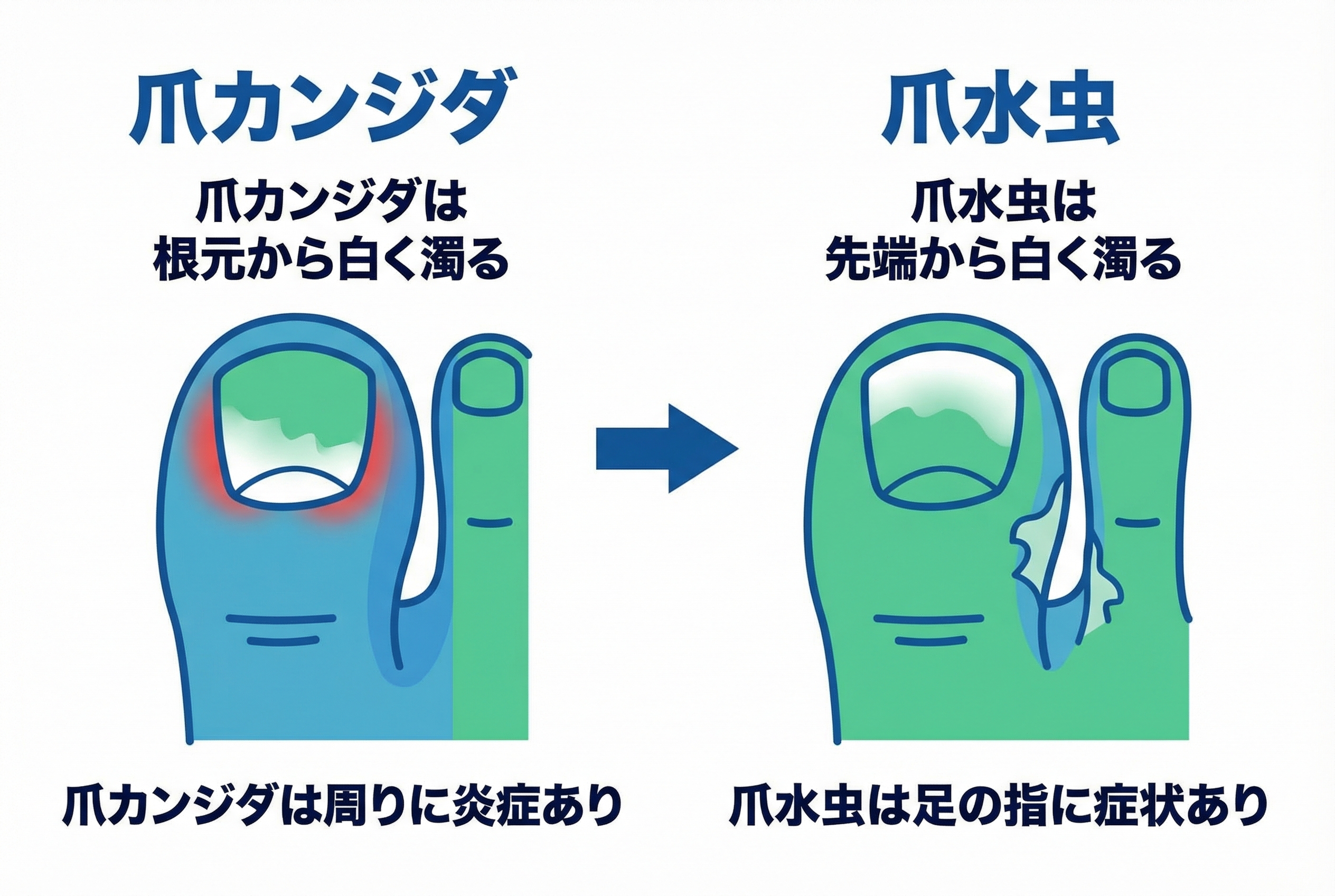 なぜ爪カンジダになる?主な原因と感染経路