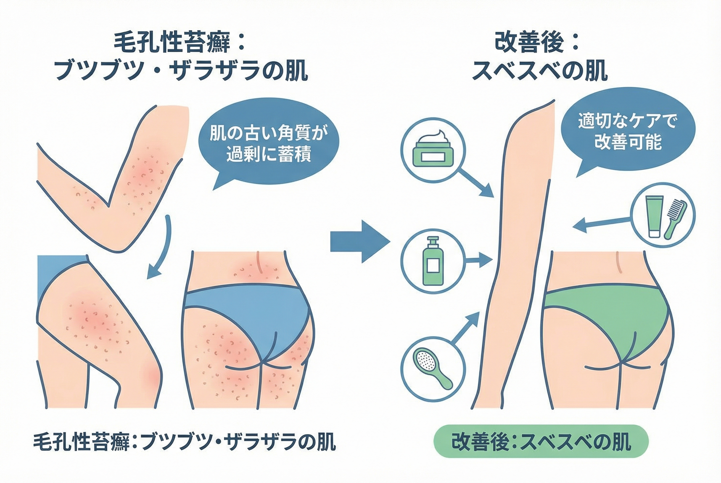 毛孔性苔癬の正体とは?主な症状と原因を解説