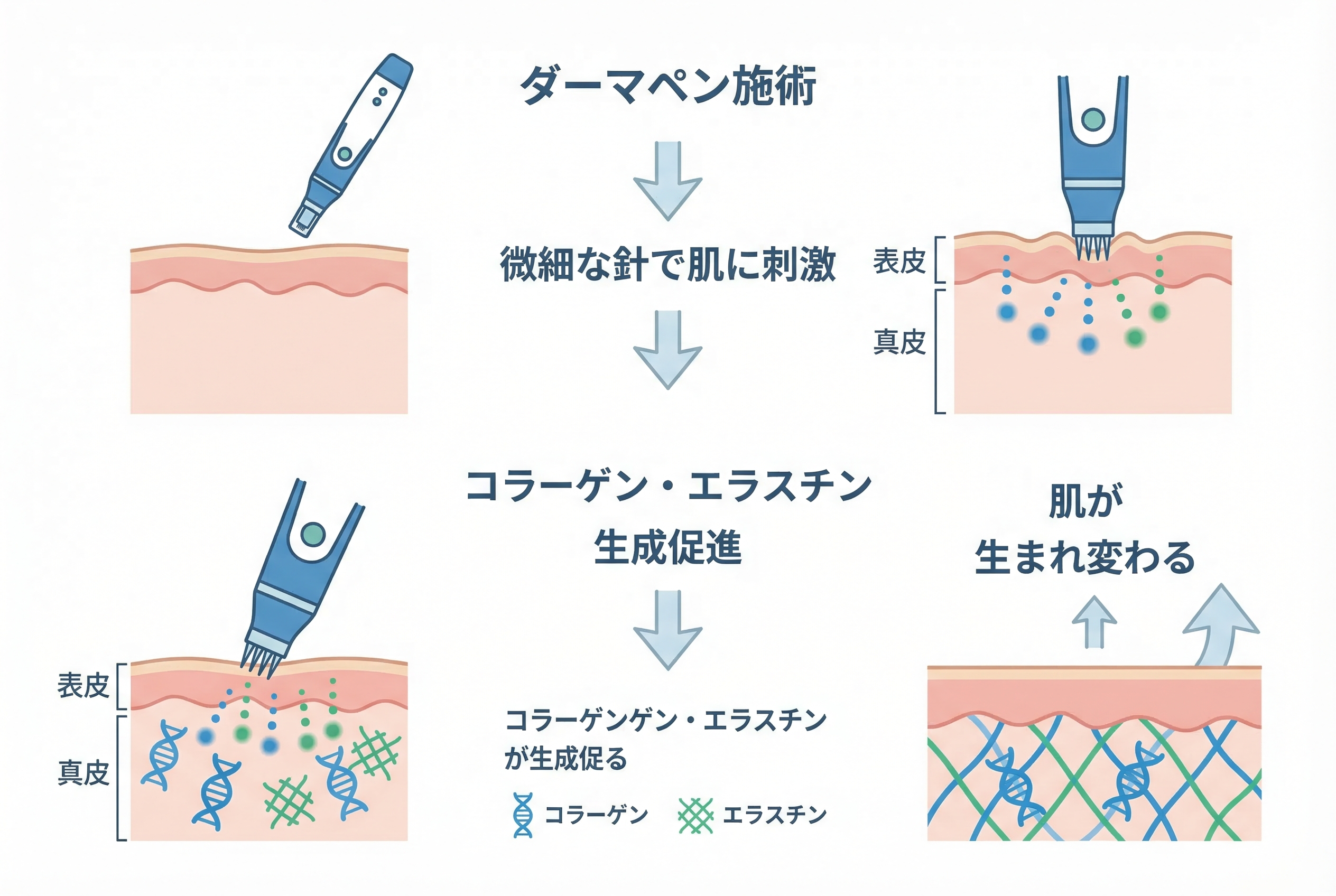 ダーマペンとは？期待できる効果のメカニズム
