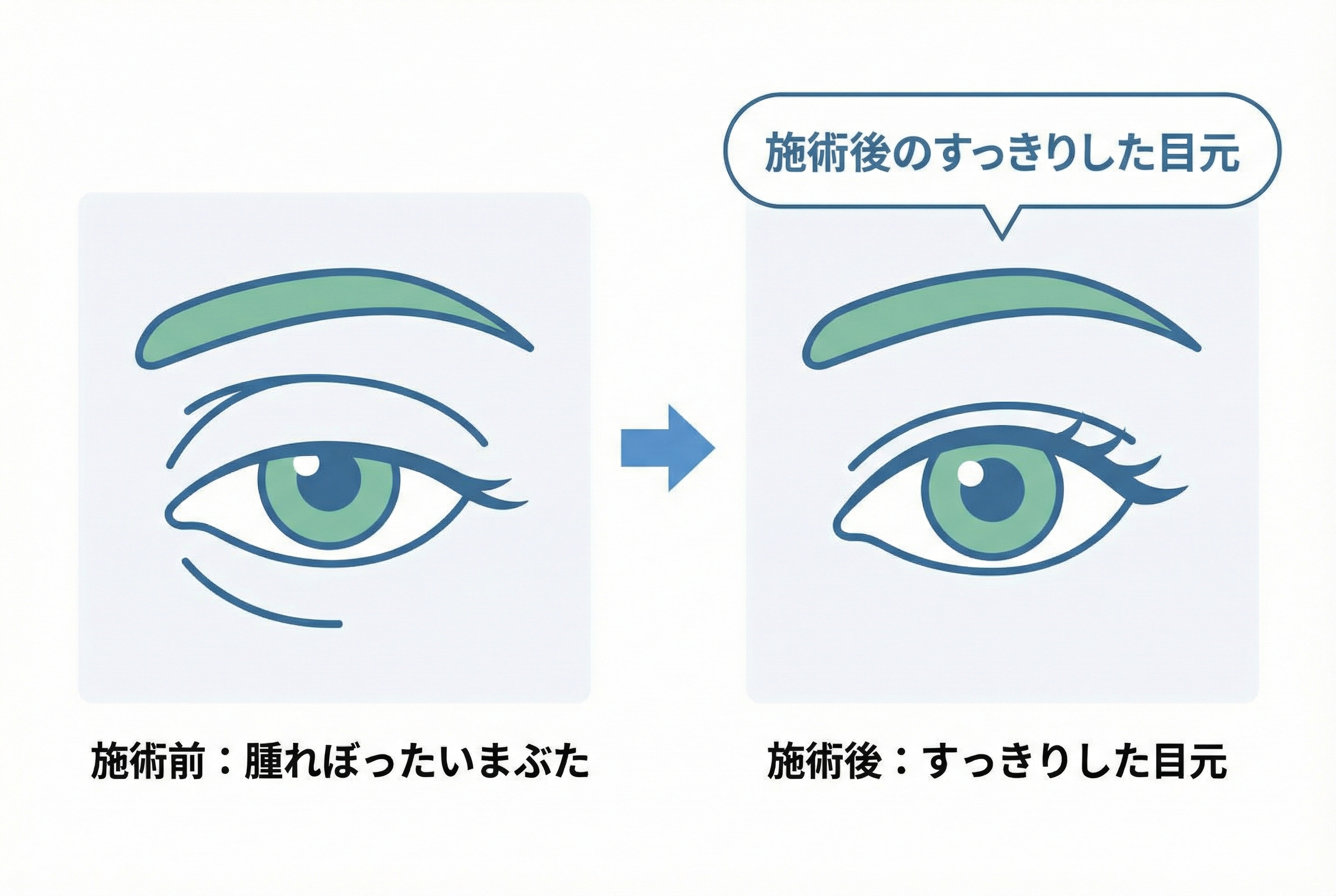 まぶたの脂肪取りで後悔しないための3つの注意点