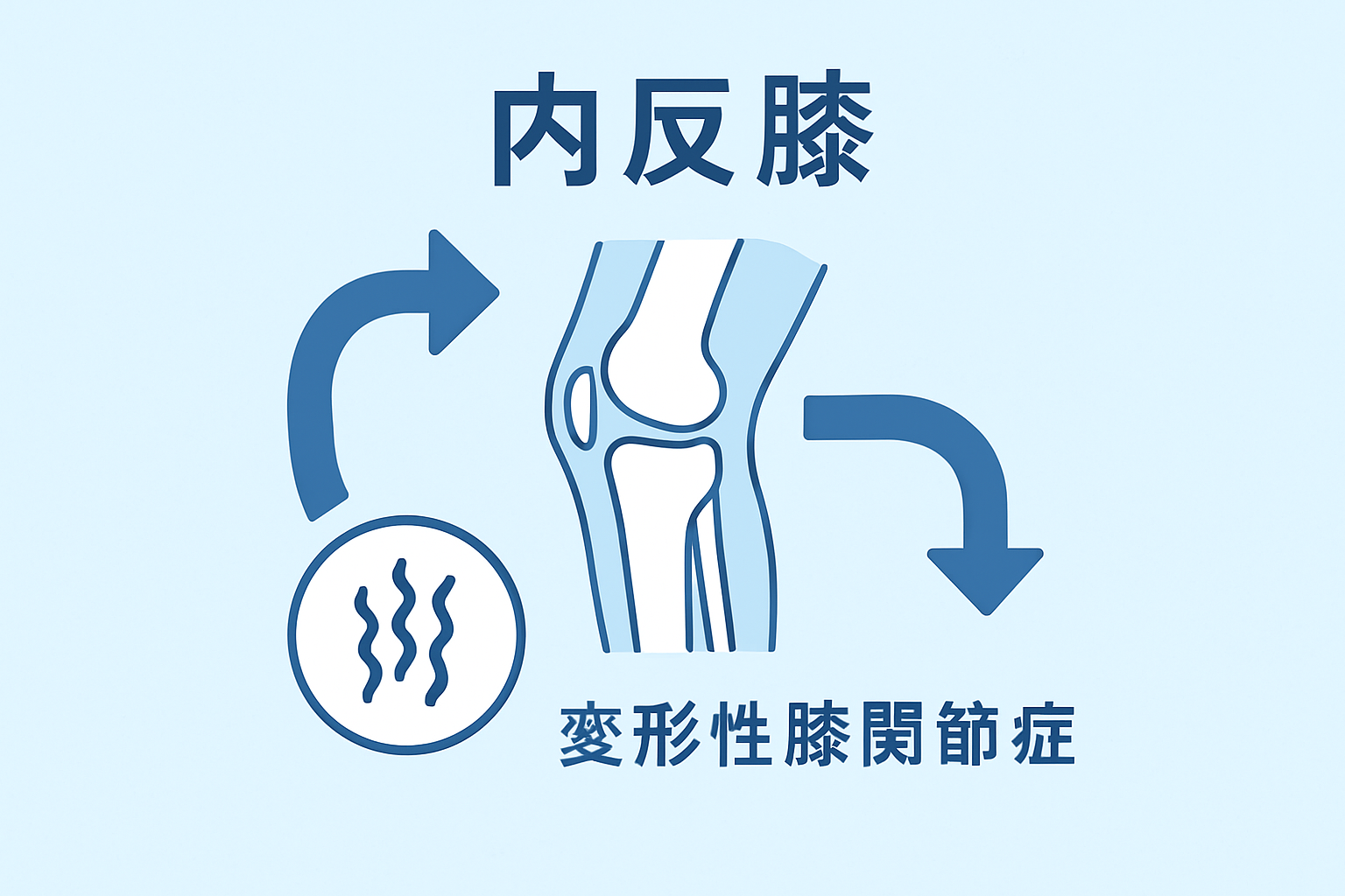 内反膝による変形性膝関節症を理解する３つのポイント