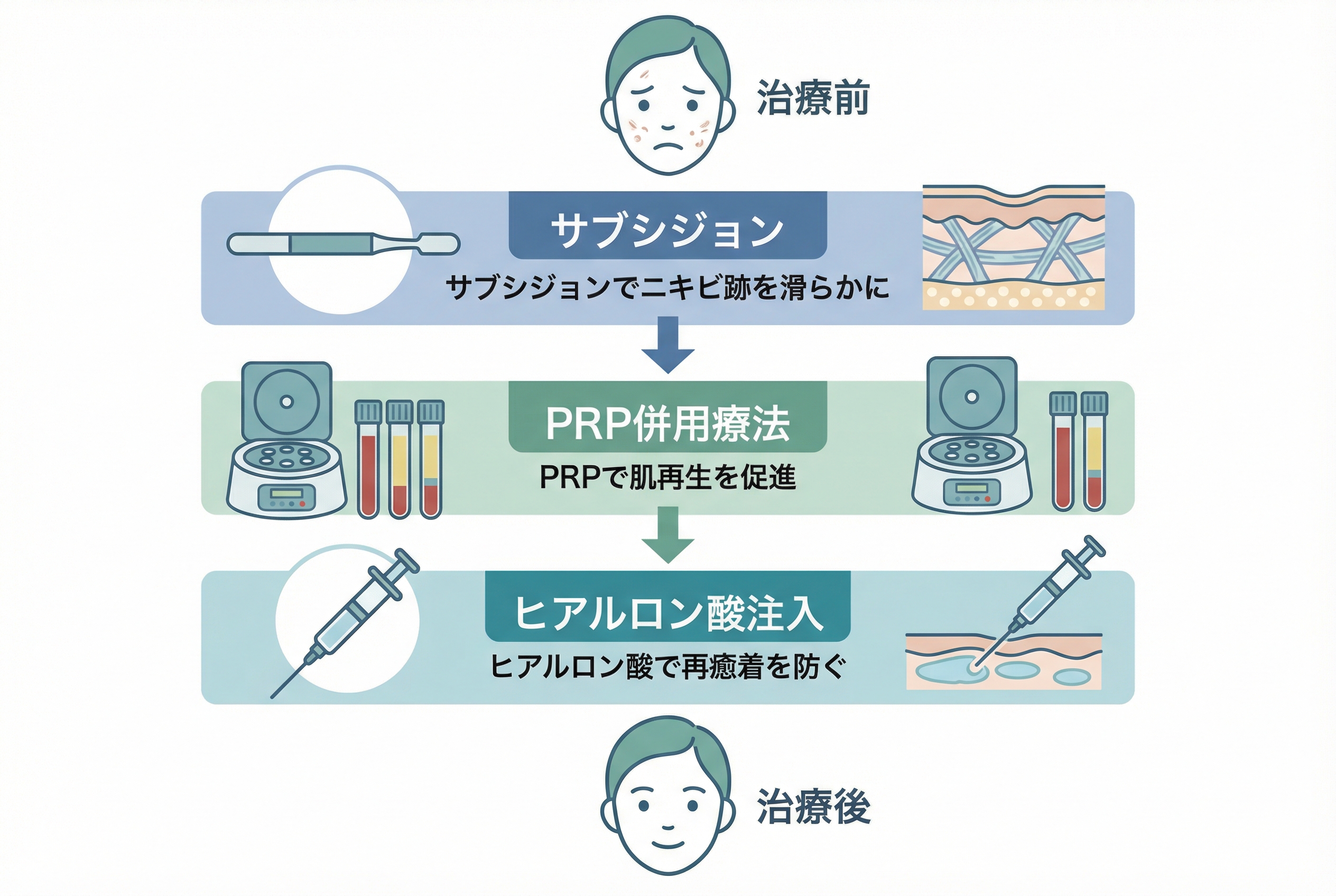 名古屋で受ける形成外科専門医によるオーダーメイドのサブシジョン治療