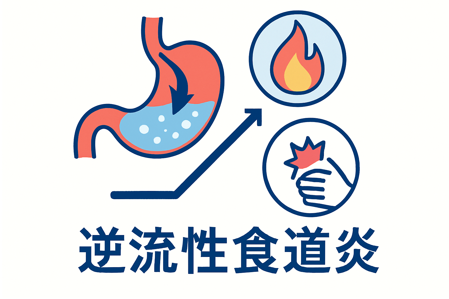 胸焼け・胃痛の原因、もしかして逆流性食道炎?その症状と原因
