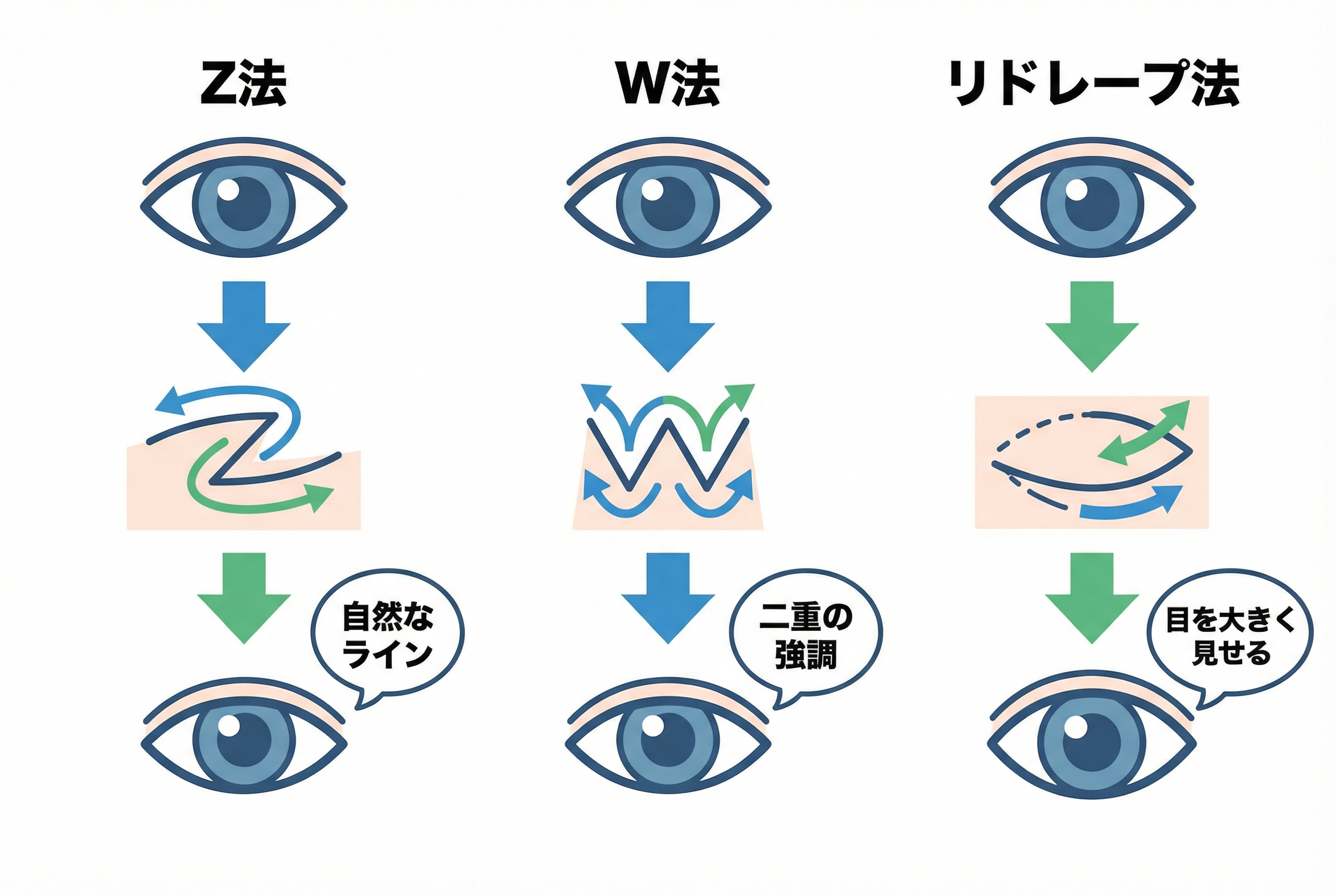 目頭切開の主な術式3種類の徹底比較