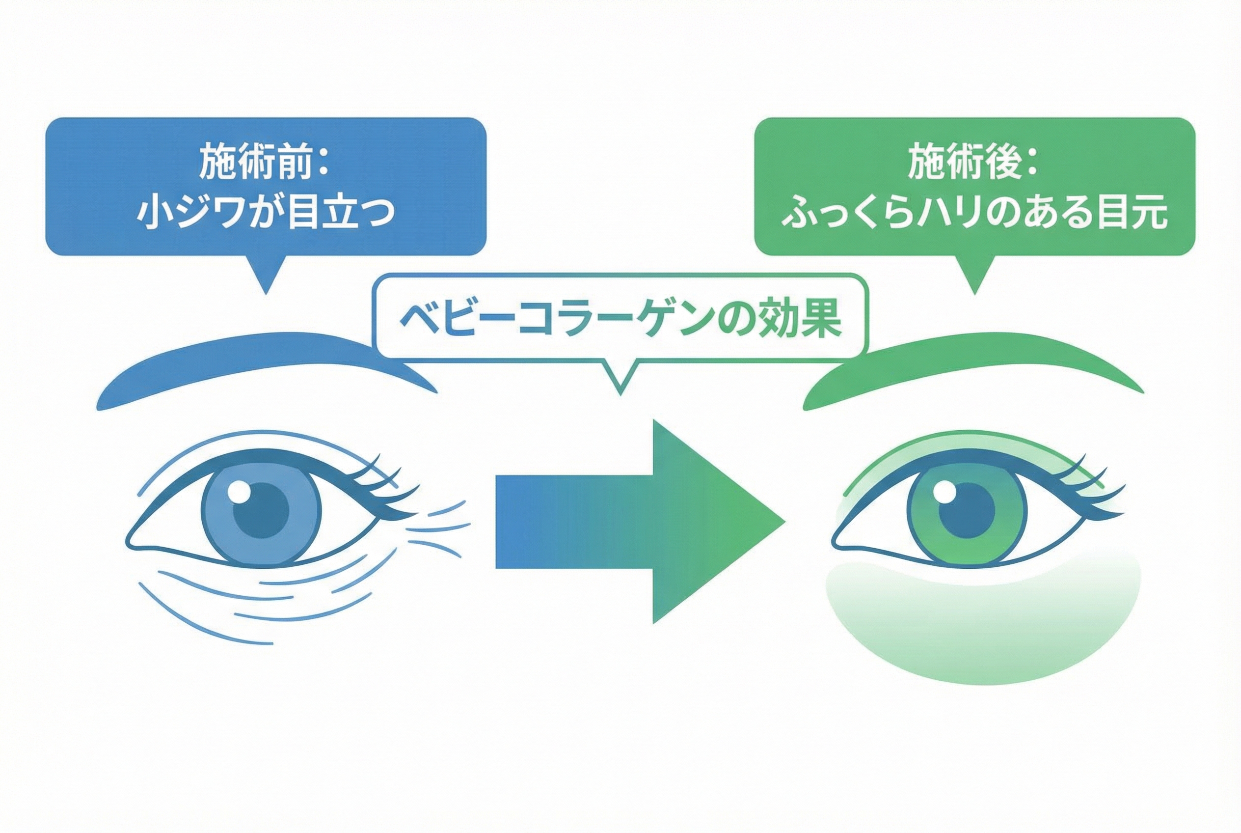 なぜベビーコラーゲンは目元の小ジワ治療に選ばれるのか