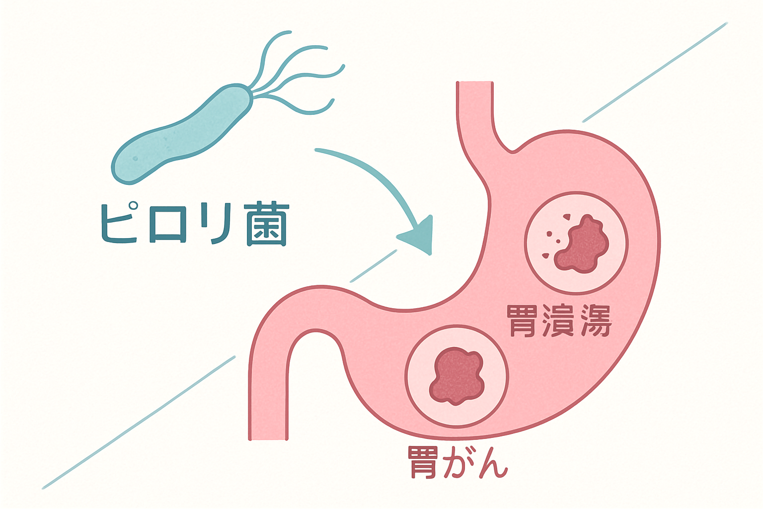 ピロリ菌ってどんな菌?胃がんとの関係は?