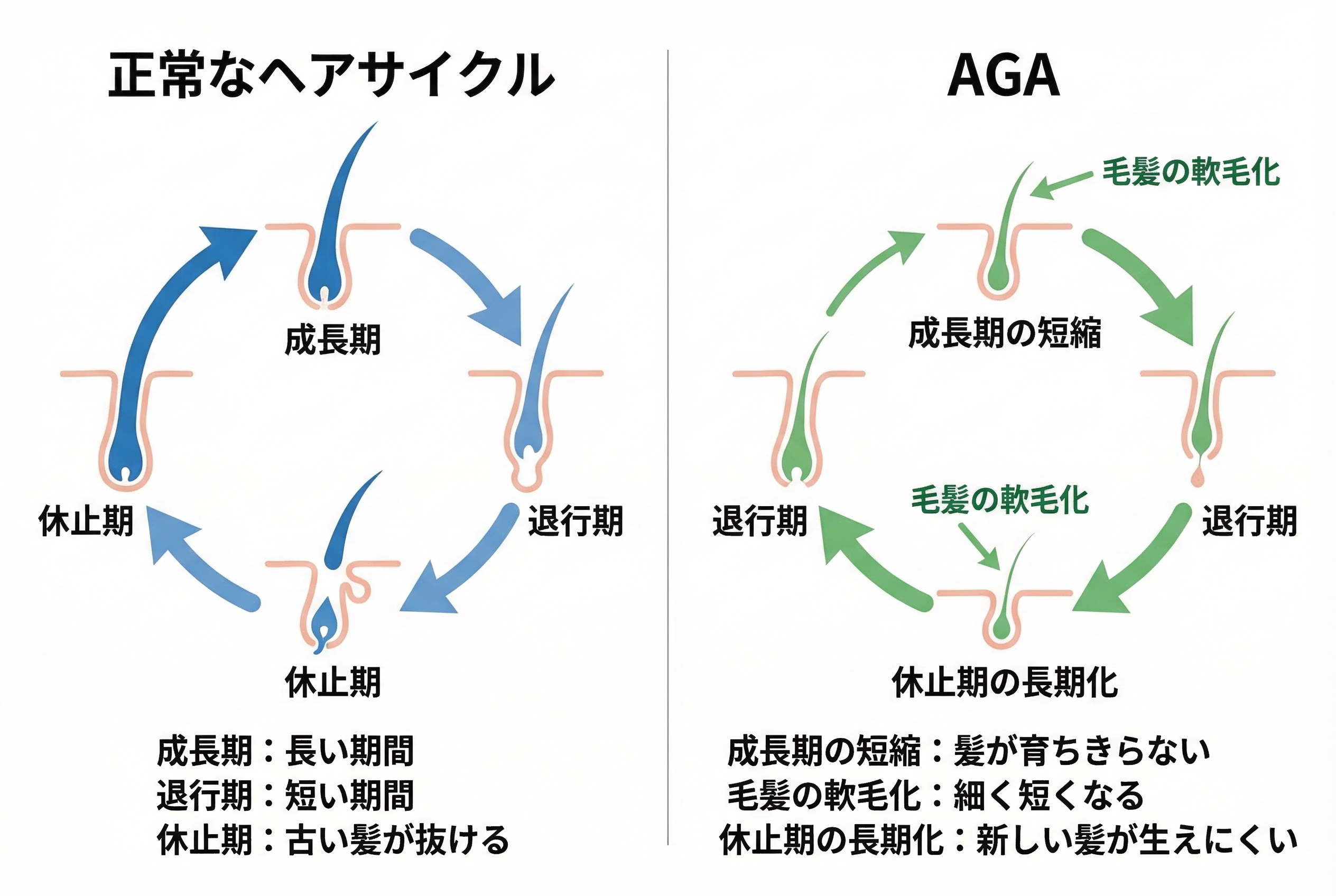 AGAと正常なヘアサイクルの違い3選