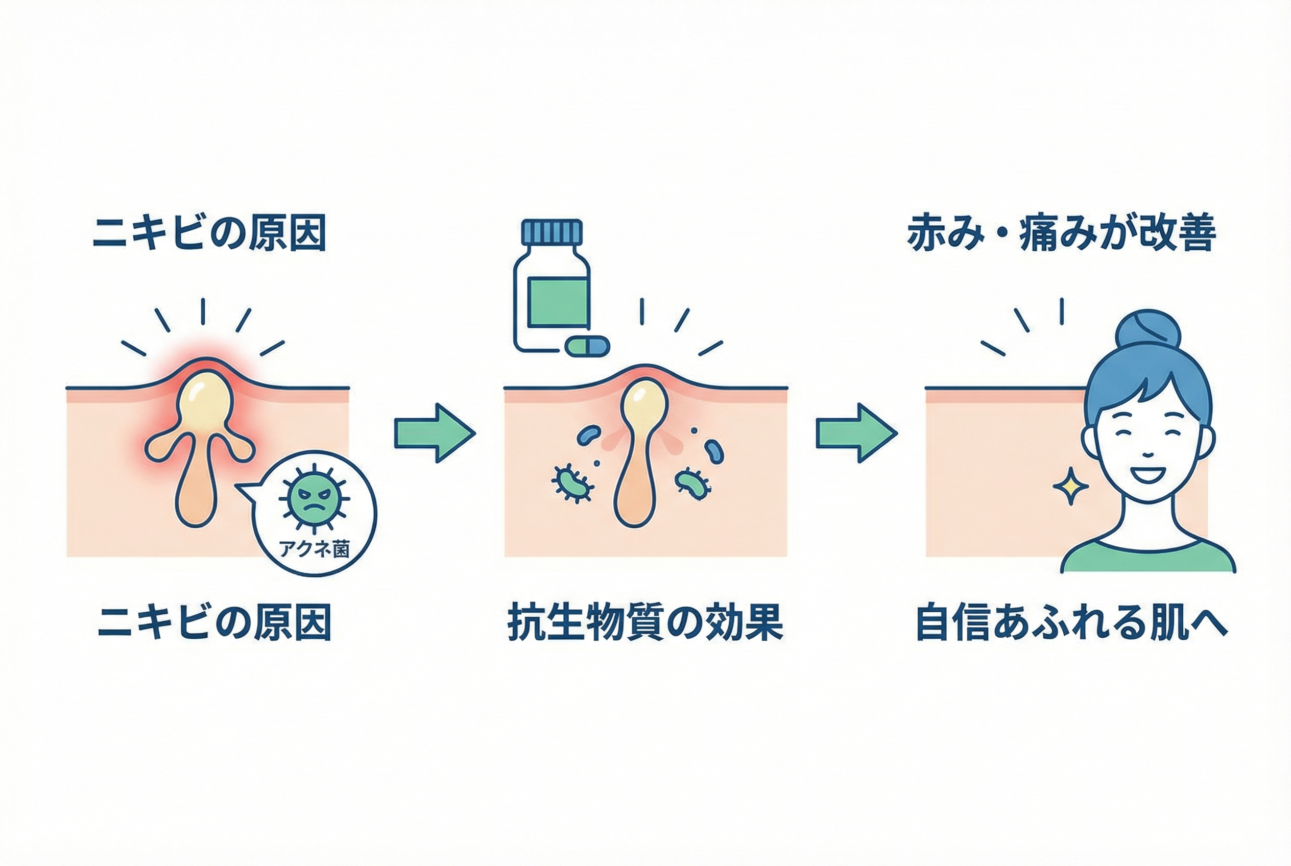 ニキビ抗生物質飲み薬の種類と効果:なぜ効くのか