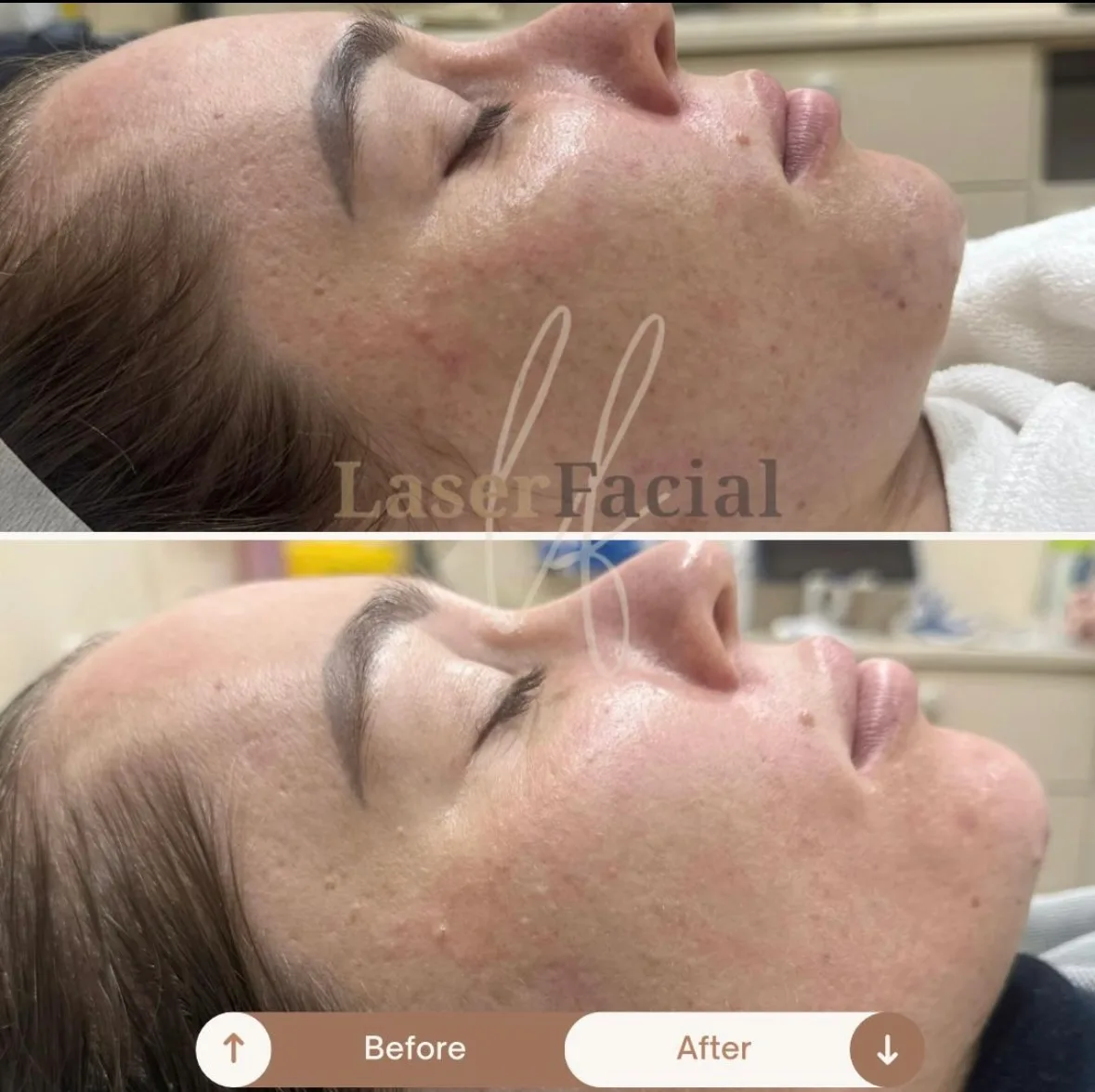 Laser facial