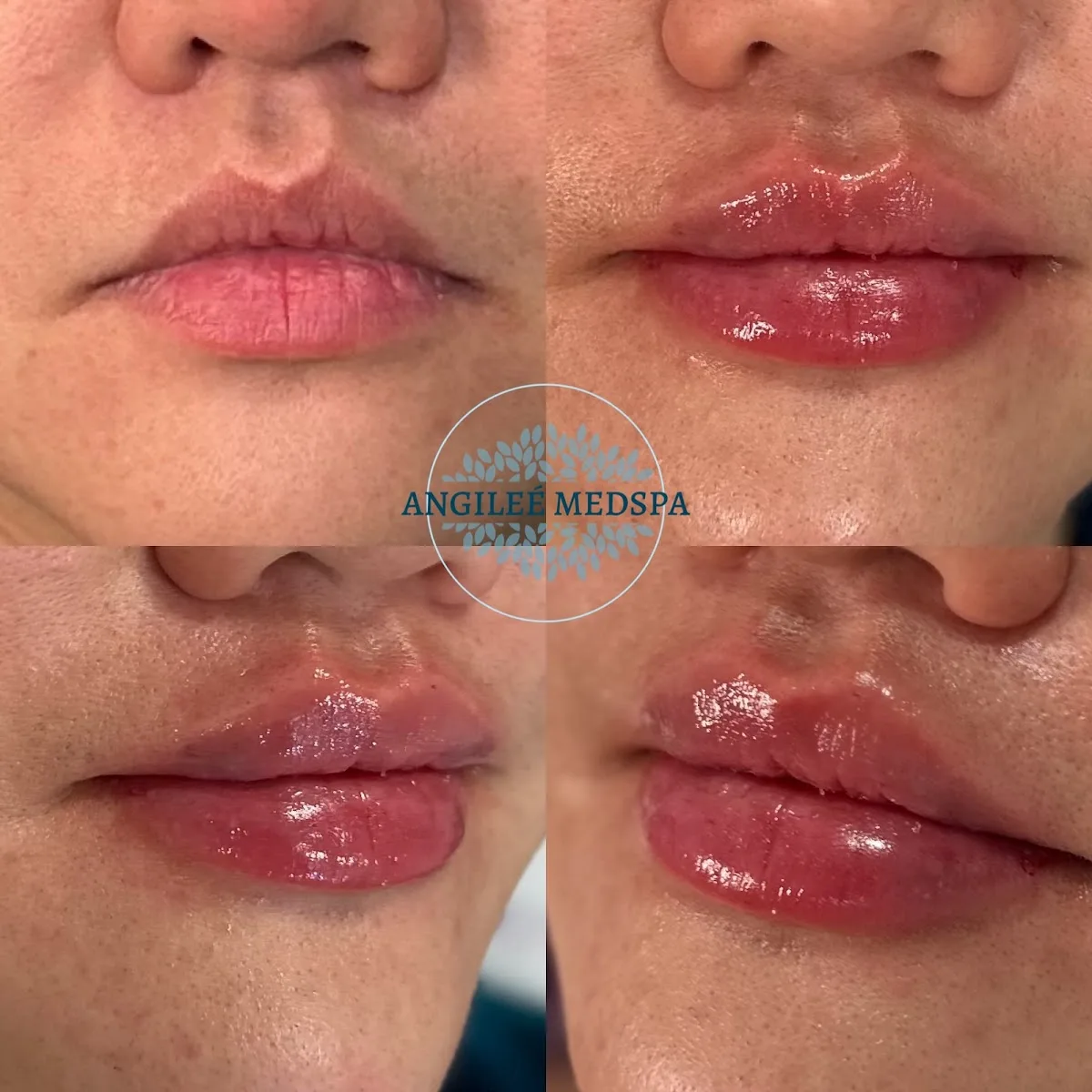 Angileé Med Spa