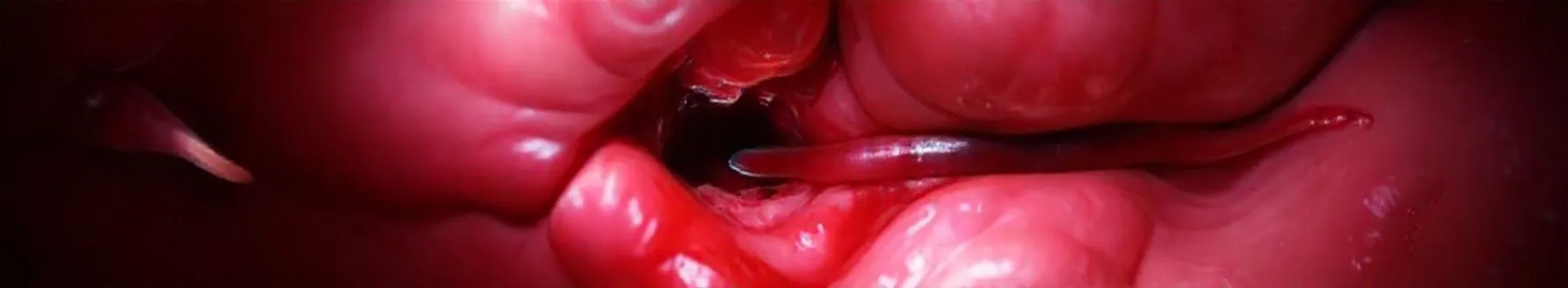 Anal abscess and Fistulas