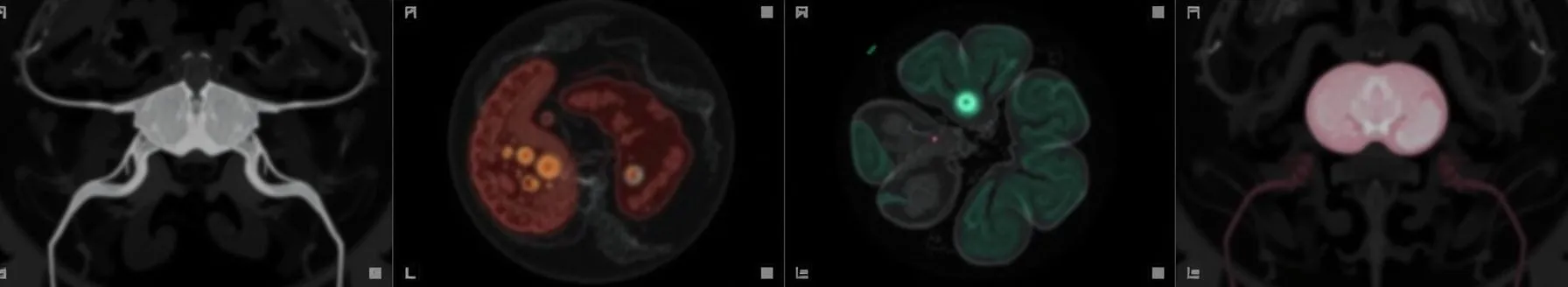 Case Discussion on Benign ovarian masses