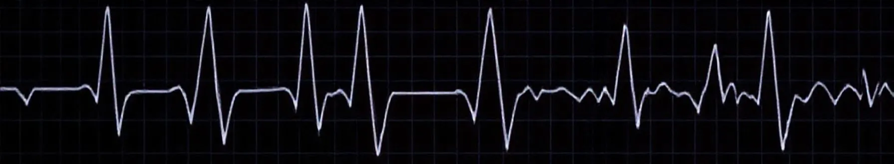 Diastolic Dysfunction: Case Overview