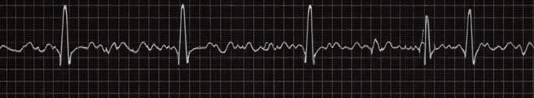 Learning ECG Through Case Study- Part 2
