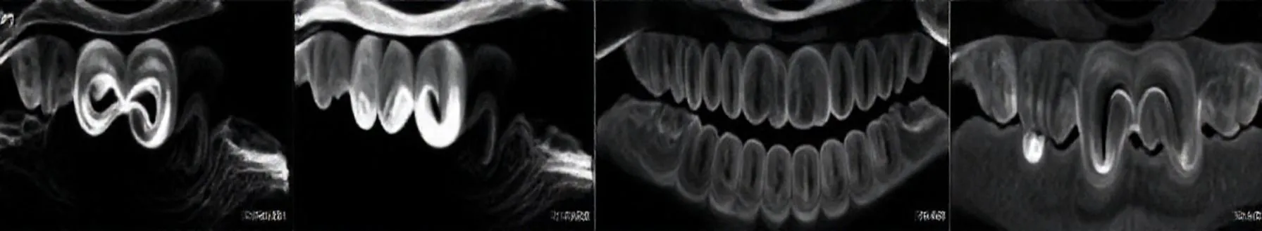 Use of CBCTs : Endodontics for Predictable Management