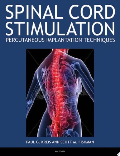 Spinal Cord Stimulation: Percutaneous Implantation Techniques