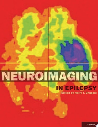 Neuroimaging in Epilepsy