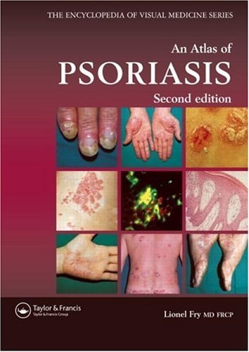 Atlas of Psoriasis