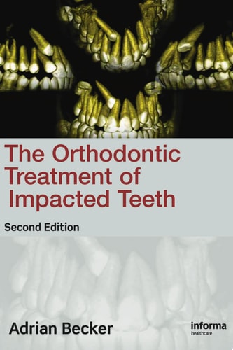 Orthodontic Treatment of Impacted Teeth